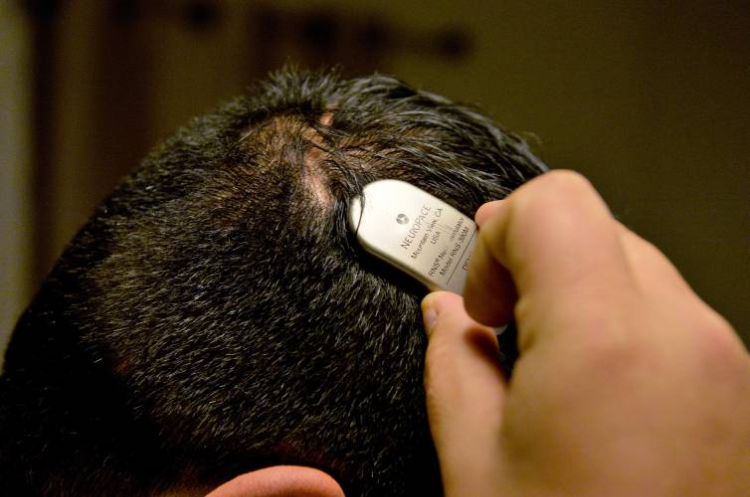 mann hält ein neuropace implantat an seinem kopf und kann damit epileptische krampfanfälle voraussagen