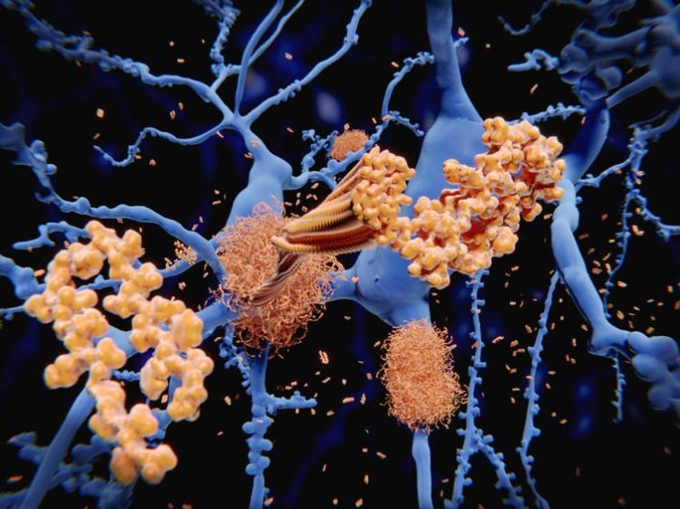 amyloid beta ablagerungen im gehirn können mit zunehmendem alter zu demenz führen