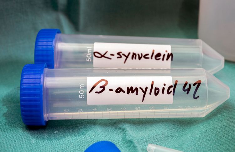 biomarker alpha synuclein und amyloid beta in zerebrospinaler flüssigkeit testen