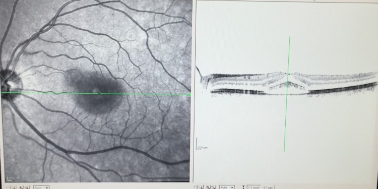 retinopathie als anomalie der augen bei patienten mit schwerem covid 19