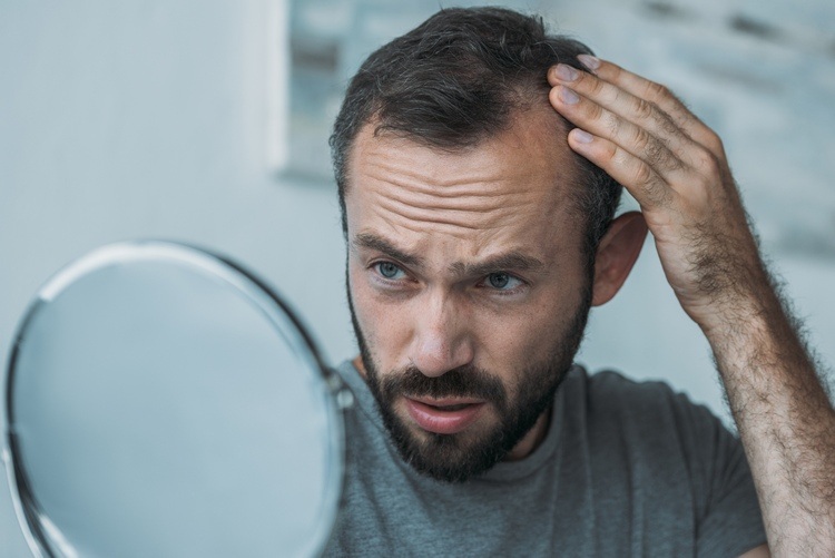 Mann mit Geheimratsecken von Haarausfall betroffen