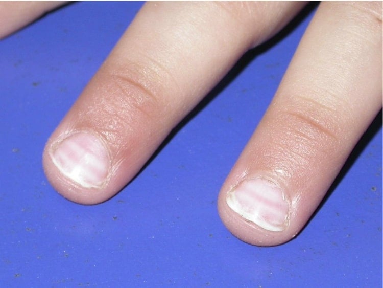 Weiße Linie auf dem Nagelbett ensteht bei Virusinfektionen.