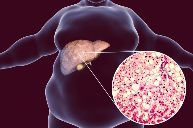 bestimmte immunzellen greifen lebergewebe bei fettleibigen menschen mit adipositas an