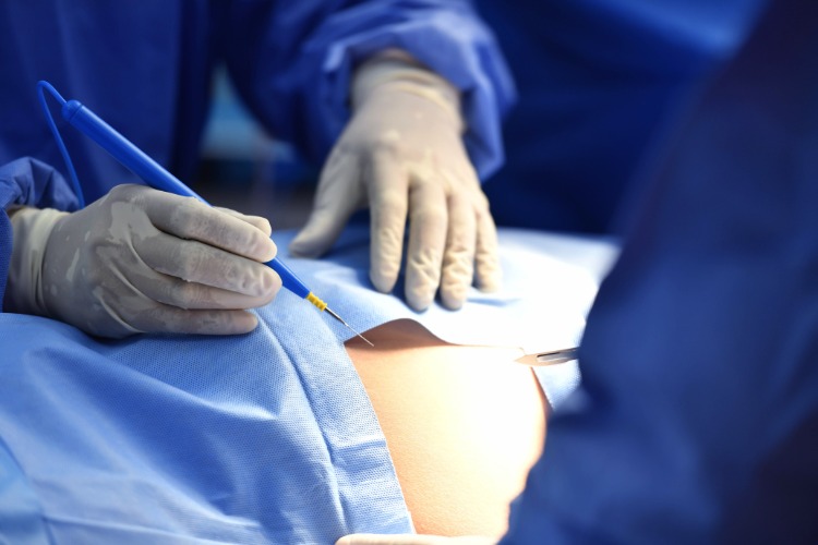 chirurg markiert die körperstelle für eine künstliche herzpumpe als implantat