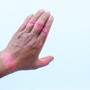 gelenkenzündung betrifft finger an der hand und verursacht funktionsverlust der knochen