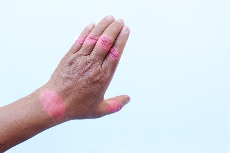gelenkenzündung betrifft finger an der hand und verursacht funktionsverlust der knochen