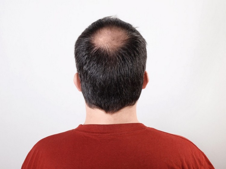 Kreisrunder Haarausfall bei Männern Tonsur am oberen Hinterkopf