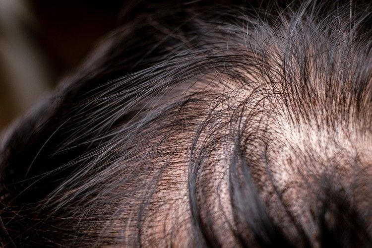 Wie sieht diffuser Haarausfall bei Männern aus