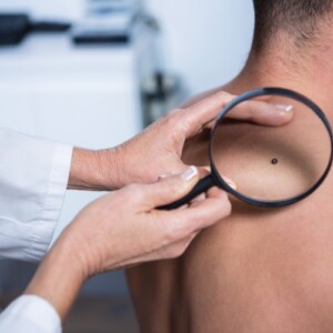 dermatologe untersucht patient bevor behandlung von hautkrebs und melanom