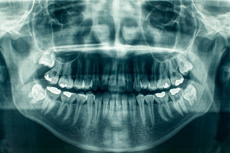 panoramische röntgenaufnahme bei zahnverlust und kognitiver rückgang bei patienten