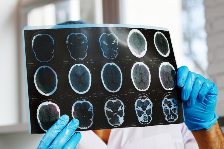 neurologe untersucht gehirnscan eines patienten mit alzheimer krankheit