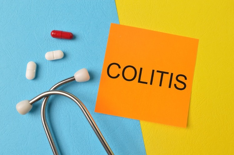 potenzielle neue behandlung von colitis ulcerosa und chronischen darmerkrankungen