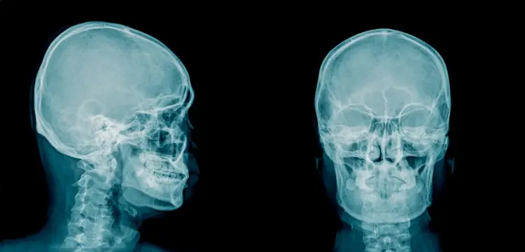 röntgenaufnahme eines menschlichen kopfes zur untersuchung der kognitiven gesundheit