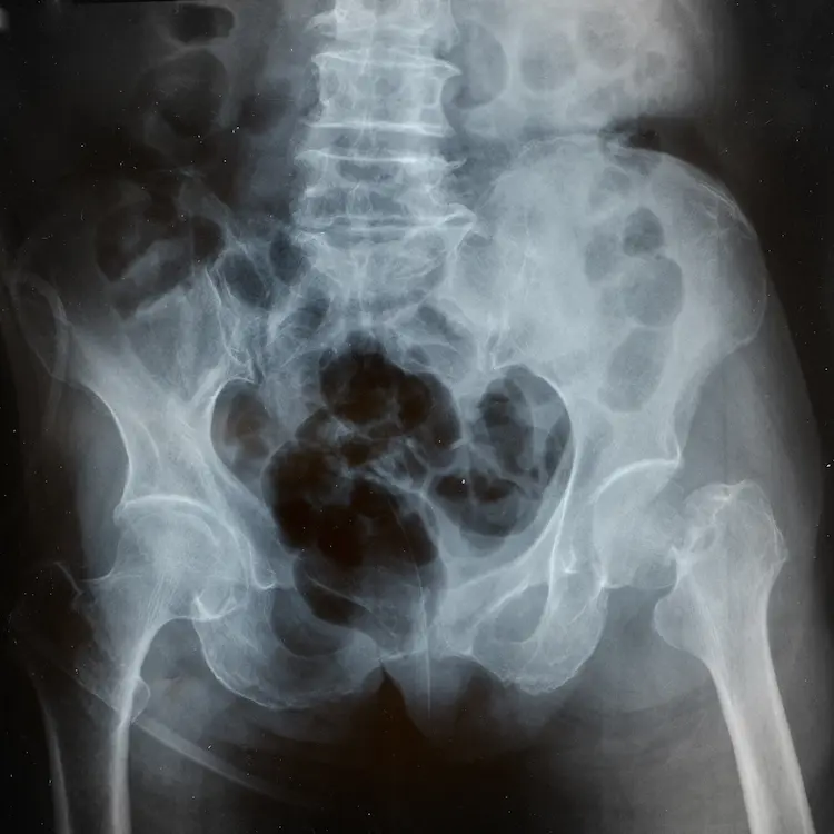 Radiografia dopo l'intervento all'anca per l'osteoporosi