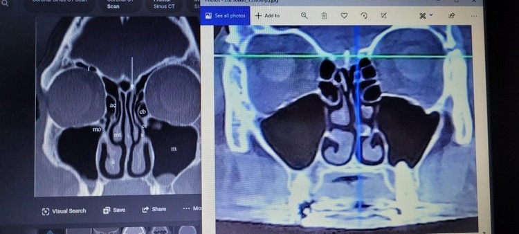 Nasenspray bei Sinusitis Kopfschmerzen und trockene Schleimhaut