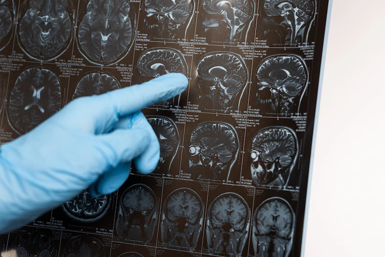 neurologe zeigt auf einem gehirnscan die folgen von alzheimer aufs gehirn auf