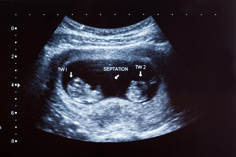 untersuchung mit ultraschall zeigt siamesische zwillinge im mutterleib