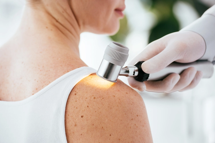 dermatologe untersucht patienin auf melanom mit speziellem instrument