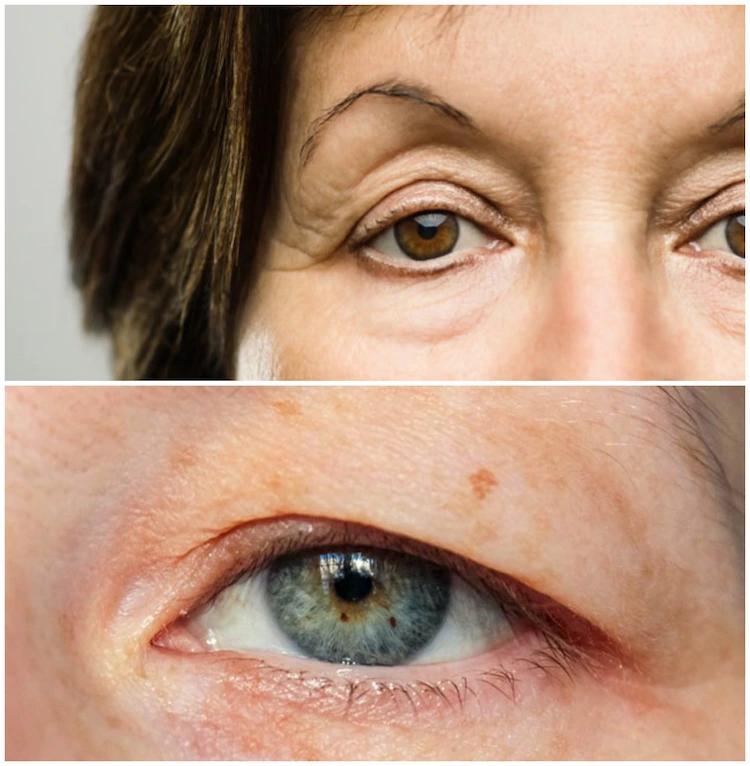 Schlecht gepflegte Haut ist die Ursache für hängende Augenlider