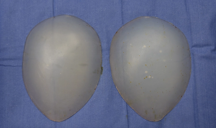 Hip Dips füllen mit Operation: Die Hüftimplantate bestehen aus einem halbfesten Silikon