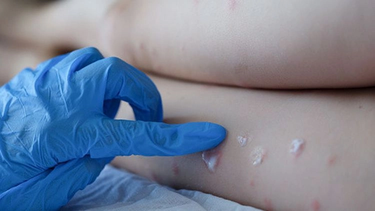 Hautausschläge auf den Handflächen, Fußsohlen und selten im Genitalbereich