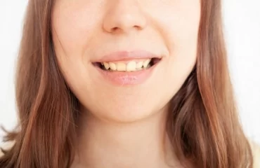 Was hilft gegen gelbe Zähne - Tipps und Ideen