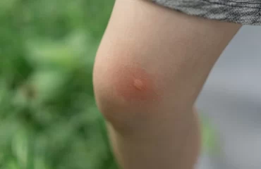 Was hilft gegen juckende Mückenstiche?