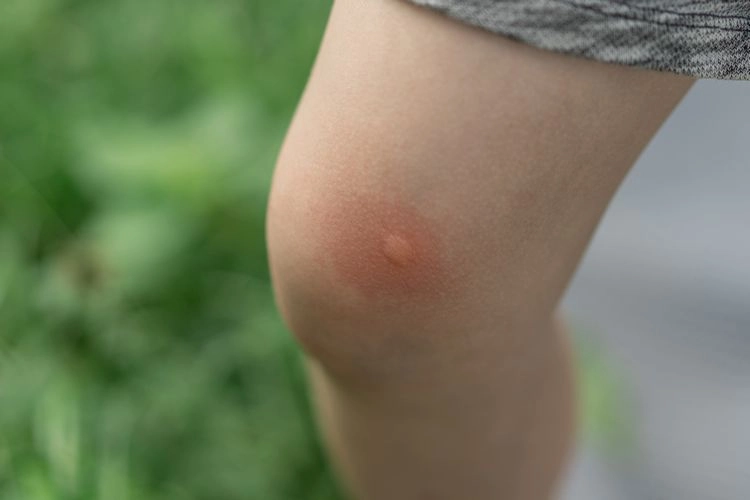 Was hilft gegen juckende Mückenstiche?