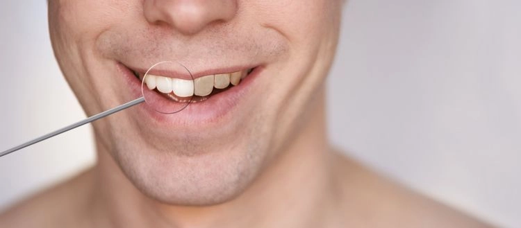 Was tun gegen gelbe Zähne?