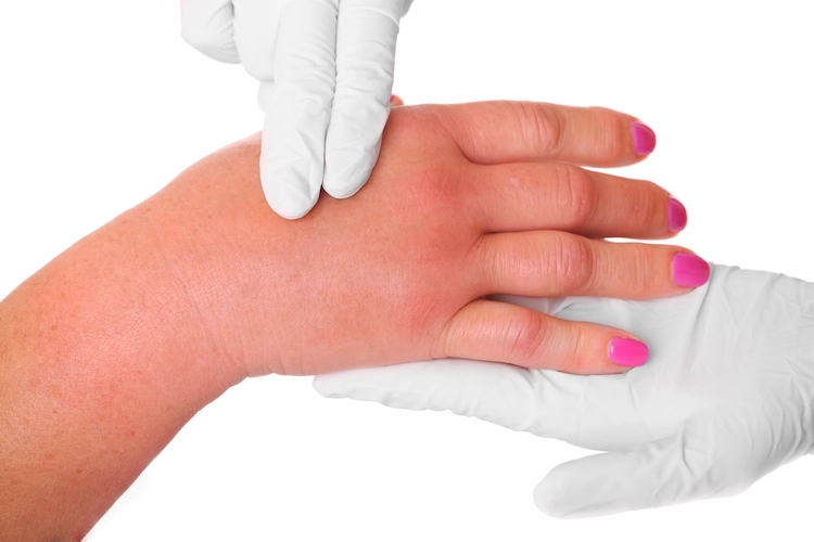 arzt untersucht geschwollene hand nach wespenstich auf allergische reaktion