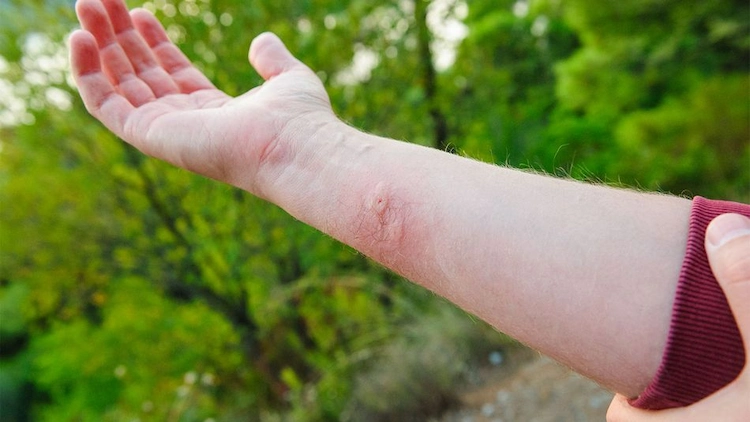 was tun nach wespenstich bei allergie und schwellungen auf der haut durch antihistaminika oder heilmittel