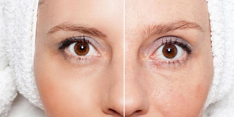 Haut ab 50 - Das Microneedling für zu Hause kann Ihre reife Haut sichtbar verjüngen und Jahre wegzaubern