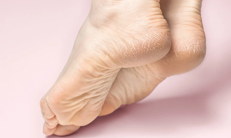 Das Fußbad mit Essig hilft bei trockener Haut, Fußpilz, Fußgeruch, Hornhaut und Warzen