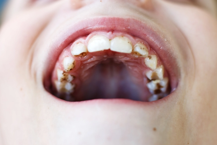 häufig bei kindern vorkommender zahnbelag oder zahnstein selbst entfernen ohne zahnarzt