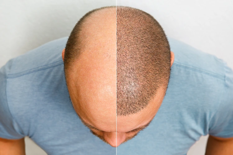 arten von alopezie bei männern