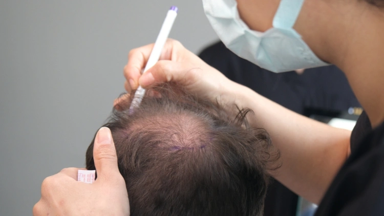 haarausfall stoppen tipps zur haartransplantation