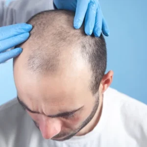 haartransplantation in der türkei beratung mit arzt