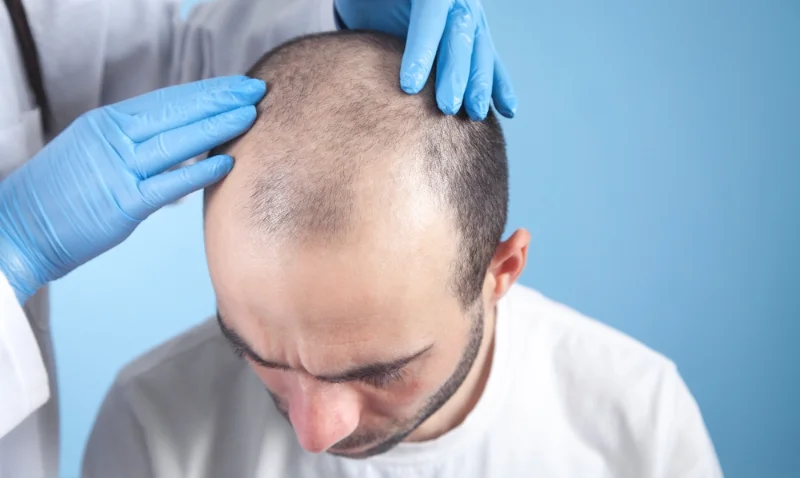 haartransplantation in der türkei beratung mit arzt