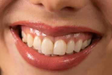 schlechte mundhygiene und plaque